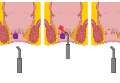 Điều trị bệnh trĩ bằng phương pháp laser